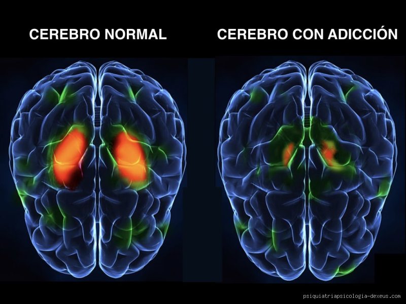 ¿Cómo saber si tengo daño cerebral por drogas?