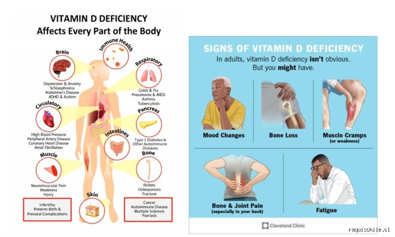 Guia definitiva sobre donde duele cuando hay falta de vitamina D y sus sintomas reales