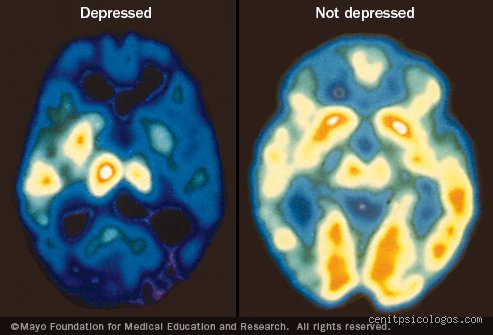 ¿Qué pasa con el cerebro cuando tienes depresión y por qué los mitos médicos fallan tanto?
