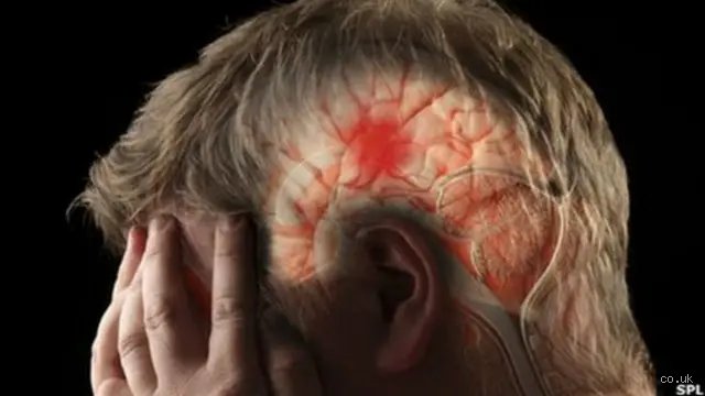 ¿Cómo empieza un derrame cerebral? Señales silenciosas y el caos biológico que detona la emergencia médica