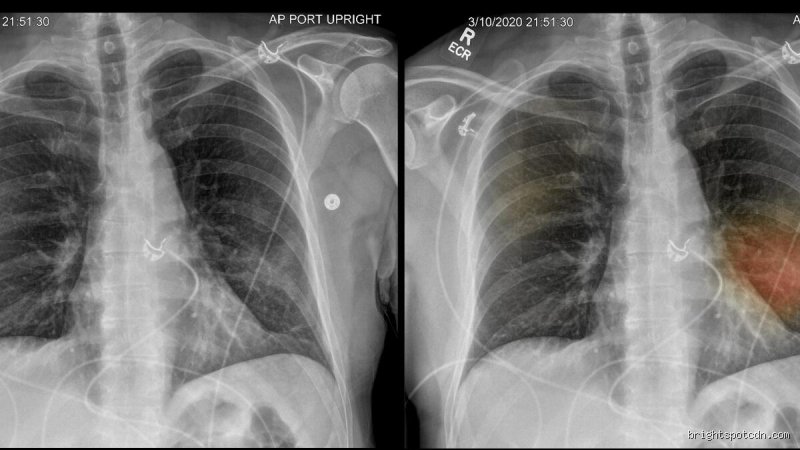 ¿Cómo se sabe si los pulmones están inflamados? La guía definitiva para detectar señales invisibles y riesgos silenciosos