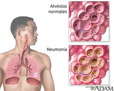 Lo que nadie te cuenta sobre cómo se siente una persona con infección en los pulmones y el peso del aire