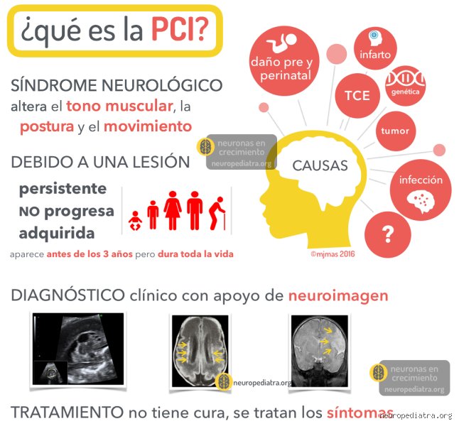 ¿Cómo se trata la parálisis cerebral en niños? Una guía realista sobre enfoques médicos actuales