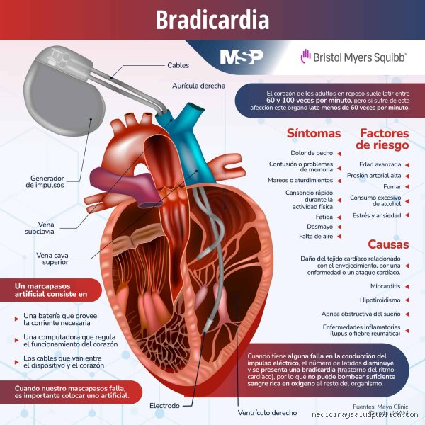 Vivir con el pulso en pausa: ¿Cómo vive una persona con bradicardia cuando el corazón decide bajar las revoluciones?