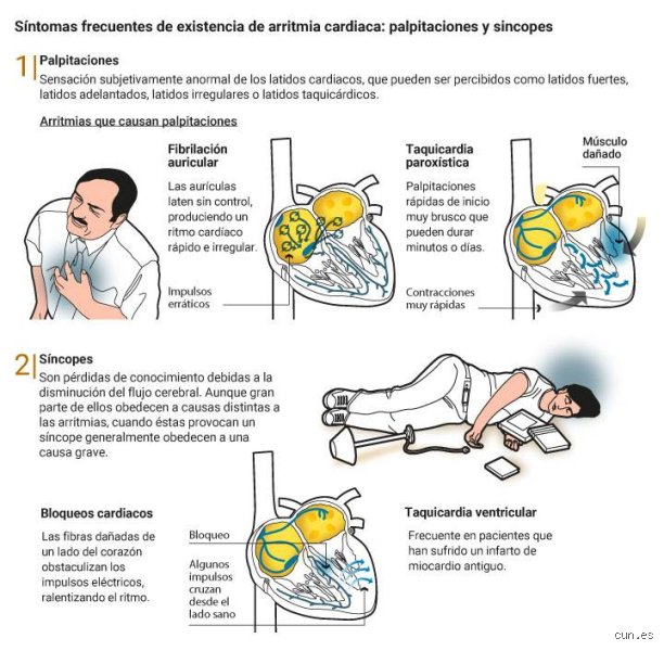 ¿Cuáles son los síntomas de la arritmia cardíaca? Guía para identificar las señales de un corazón que pierde el compás