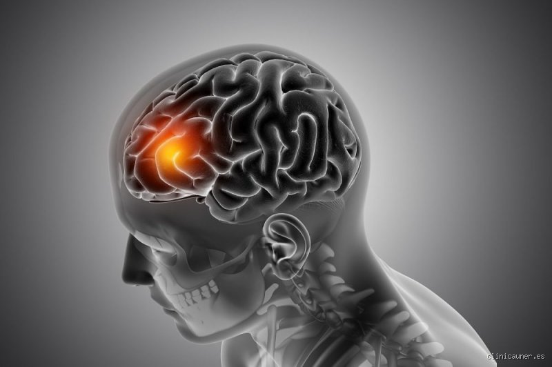 ¿Es el daño neurológico reversible o estamos condenados a vivir con las cicatrices del cerebro?