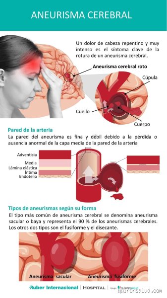 ¿Dónde duele cuando hay aneurisma cerebral? Localización del dolor y señales de alerta que salvan vidas