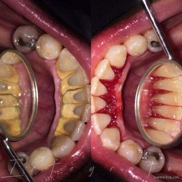¿Cuánto tarda en salir el sarro de los dientes?