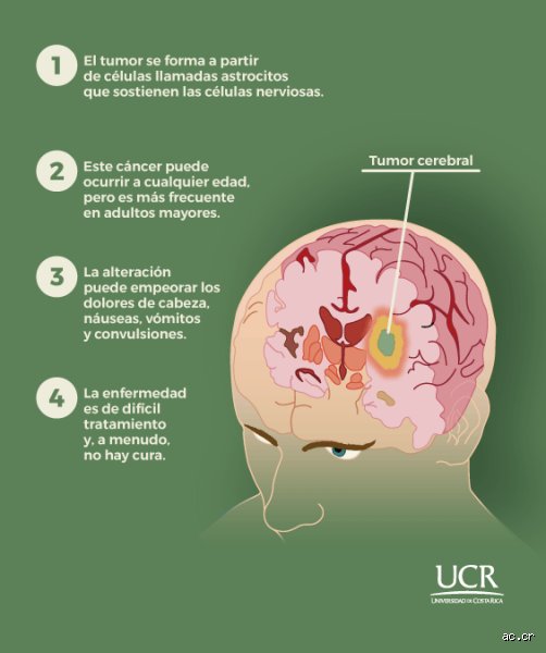 ¿Se puede prevenir el glioblastoma?