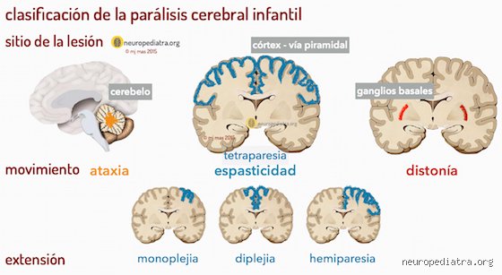 Entendiendo la Parálisis Cerebral Infantil: Una Mirada Profunda al Trastorno Motor Más Frecuente en la Infancia (Parte 1)