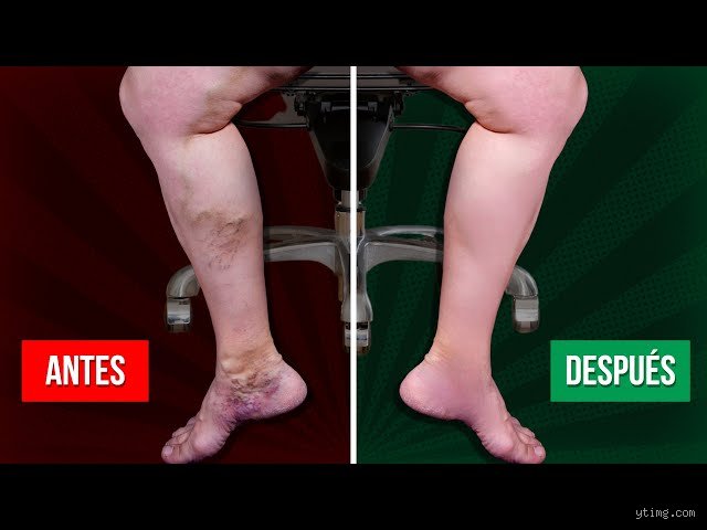¿Ayuda elevar las piernas con los coágulos de sangre?
