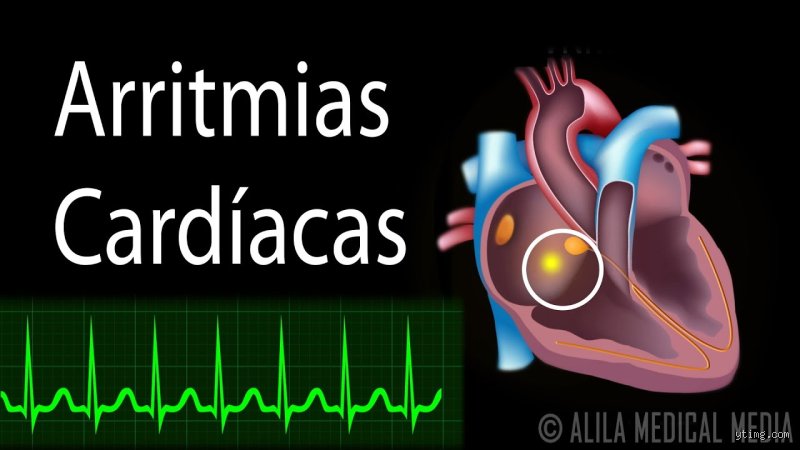¿Cómo suena una arritmia cardíaca?