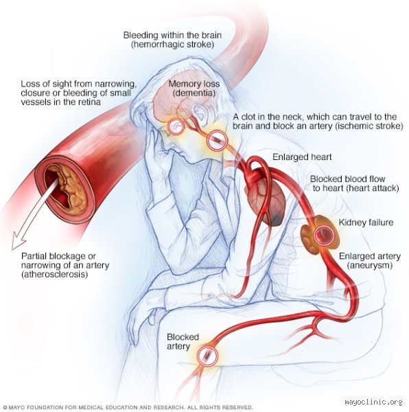 ¿Cuál es el órgano que causa la presión arterial alta?