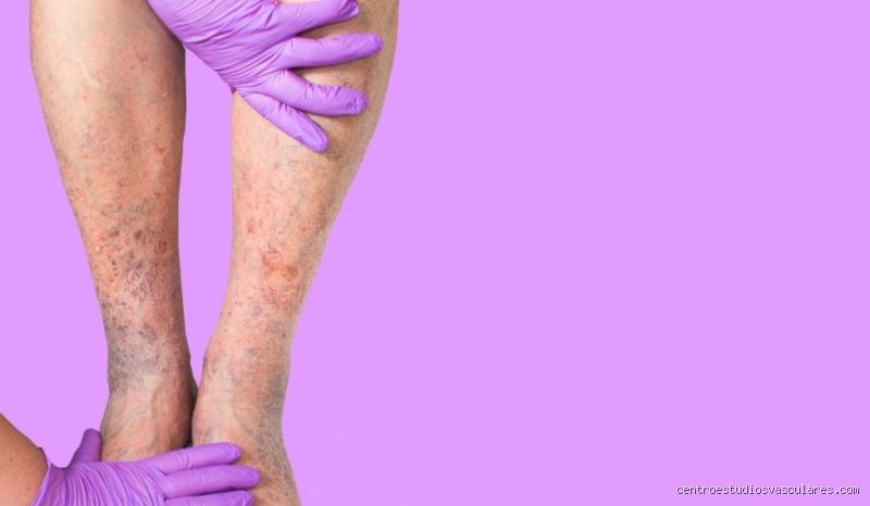¿Cuál es el peor enemigo de las varices?
