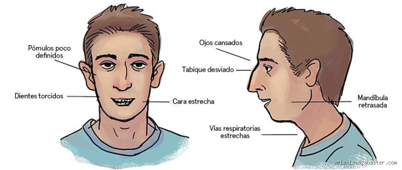 ¿Respirar por la boca es perjudicial para la estructura facial?