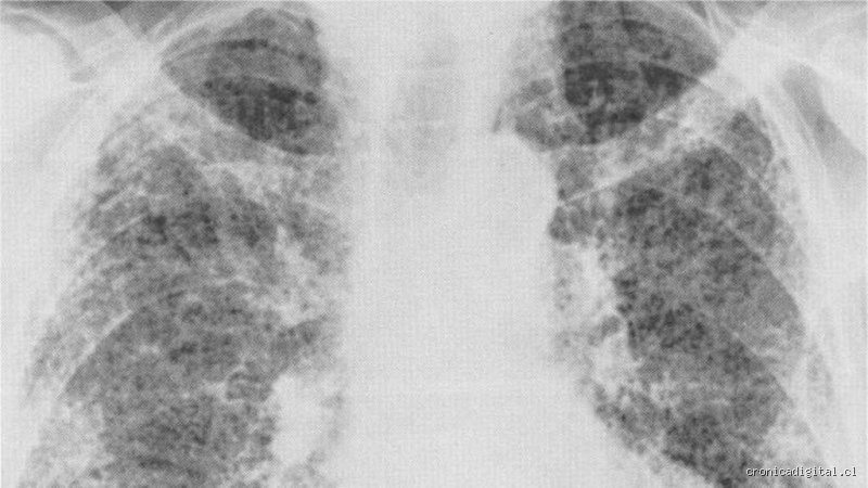 ¿Alguien ha logrado revertir alguna vez la fibrosis pulmonar?