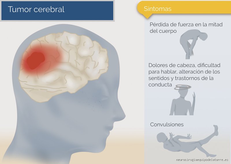 ¿Cómo comienza el cáncer en el cerebro?