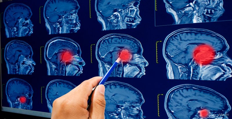 ¿Cómo evitar el cáncer de cerebro?