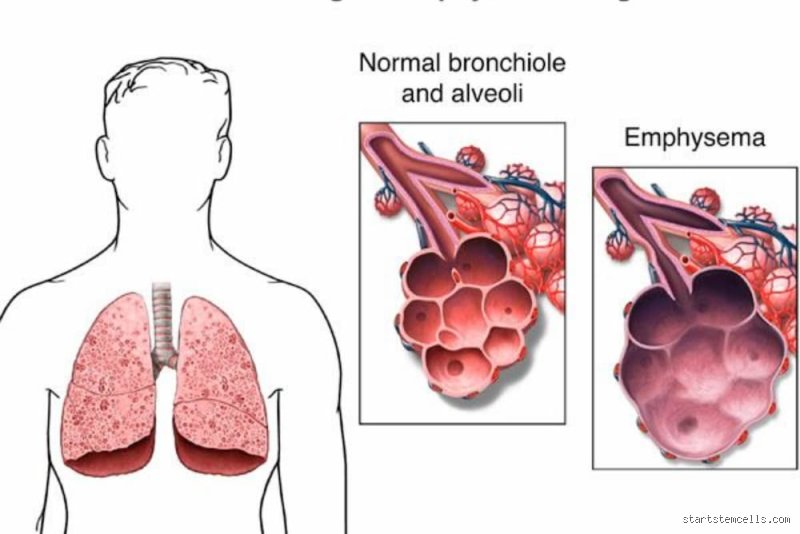 ¿Cómo frenar el enfisema pulmonar?