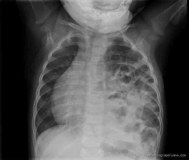 ¿Cómo respira un niño con neumonía?