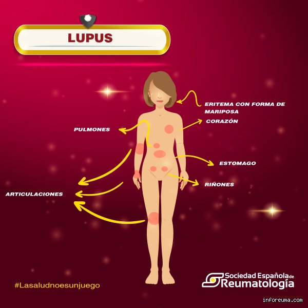 ¿Cómo saber si estoy desarrollando lupus?