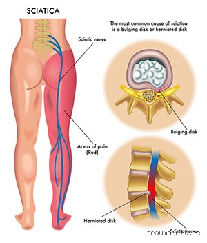 ¿Cómo saber si tengo problemas en los nervios de las piernas?