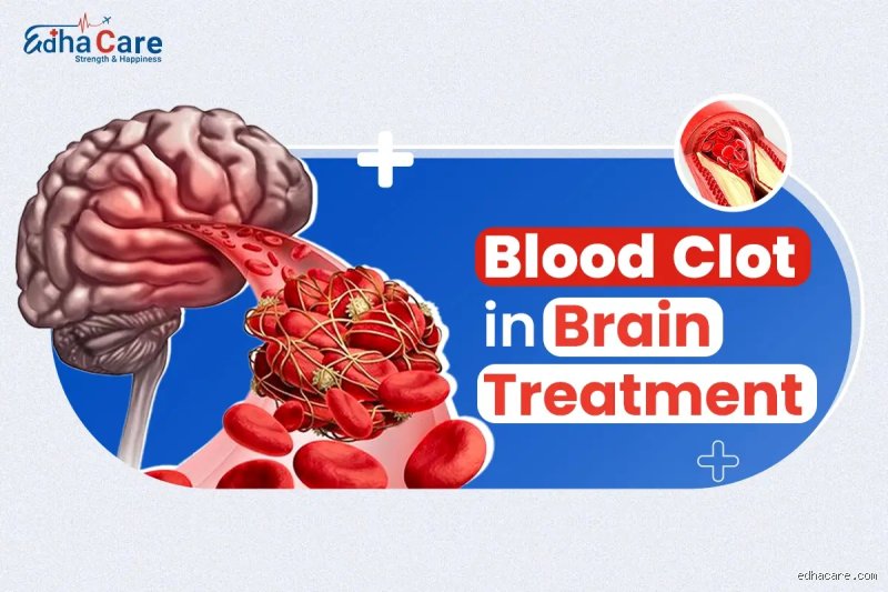 ¿Cómo se deshacen los coágulos de sangre en el cerebro?