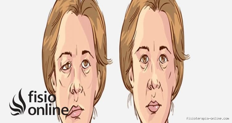 ¿Cómo se dice parálisis en términos médicos?
