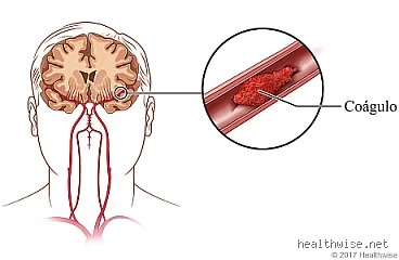 ¿Cómo se elimina un coágulo de sangre en el cerebro?