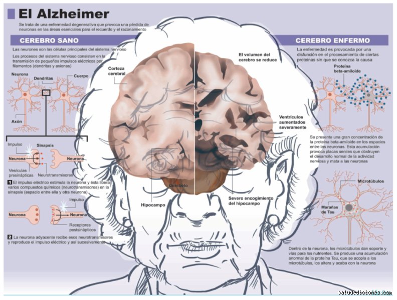¿Cómo se llama la enfermedad que deteriora el cerebro?