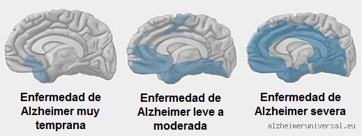 ¿Cómo se ve la demencia en etapa 1?