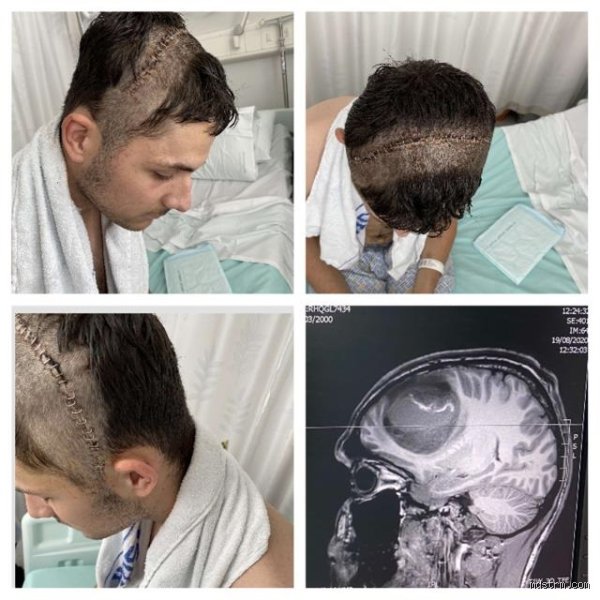 ¿Cuál es el peor cáncer de cabeza?