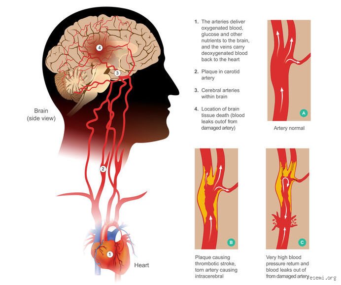 ¿Cuál es la enfermedad cerebral más mortal?