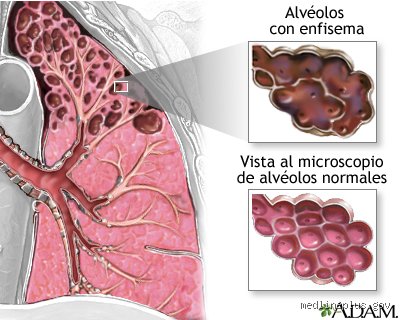 ¿Cuál es la enfermedad pulmonar más grave?