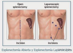 ¿Cuál es la infección más común que afecta al bazo?