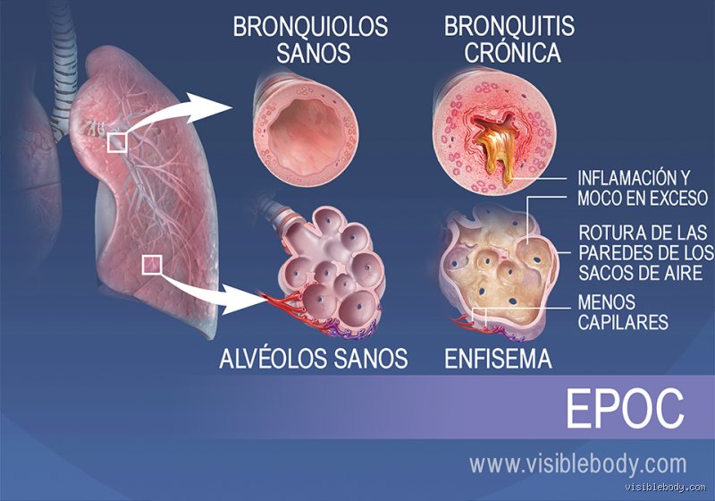 ¿Cuáles son dos enfermedades que afectan a los pulmones?