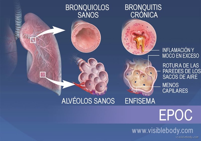 ¿Cuáles son las 4 enfermedades respiratorias?