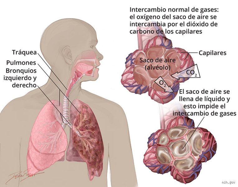 ¿Cuáles son las causas comunes de dificultad para respirar?
