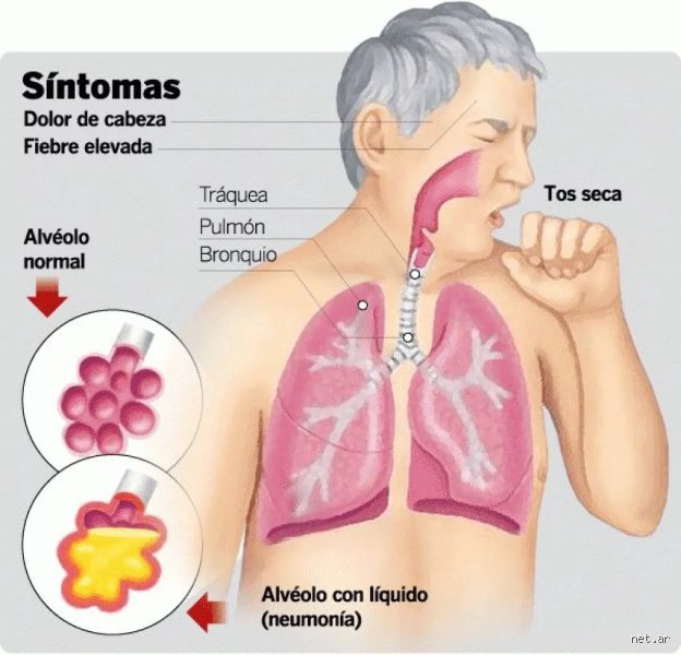 ¿Cuando tienes neumonía toses mucho.?