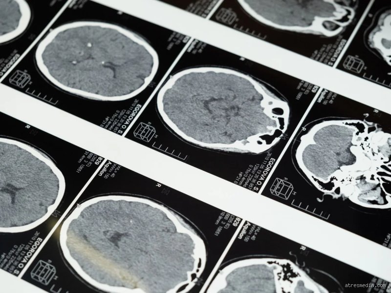 ¿Cuánto tiempo tarda el cerebro en repararse a sí mismo?