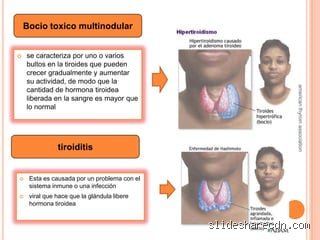 ¿Diferencia entre hiperparatiroidismo y hipertiroidismo?