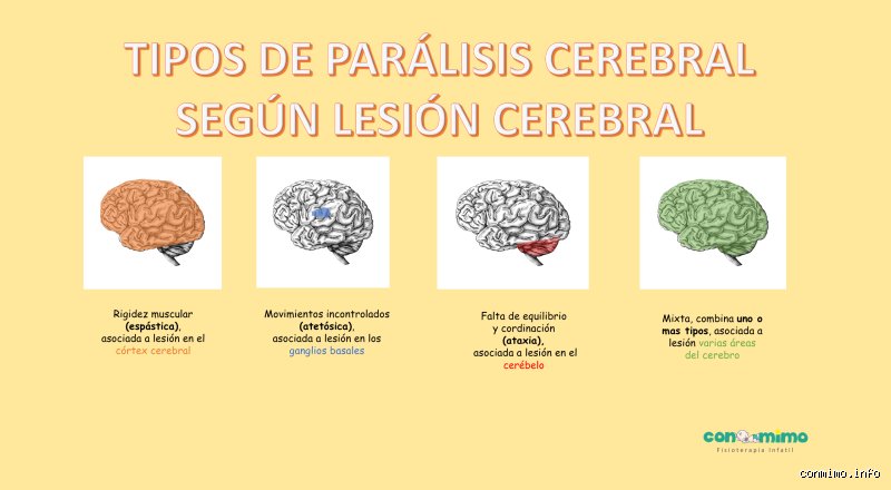 ¿Diferencia entre parálisis cerebral y daño cerebral?