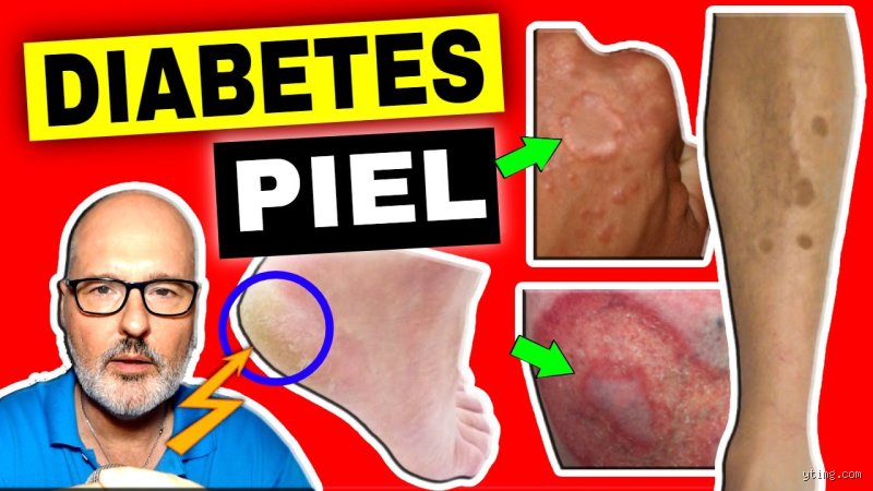 ¿Dónde da picazón la diabetes?