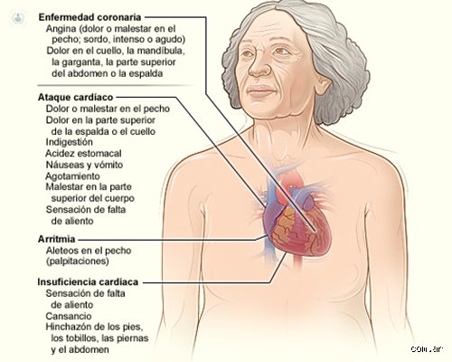 ¿Dónde duele cuando hay angina de pecho?