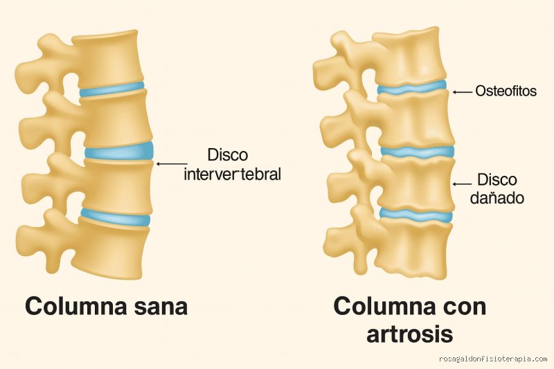 ¿Dónde duele cuando hay artrosis cervical?