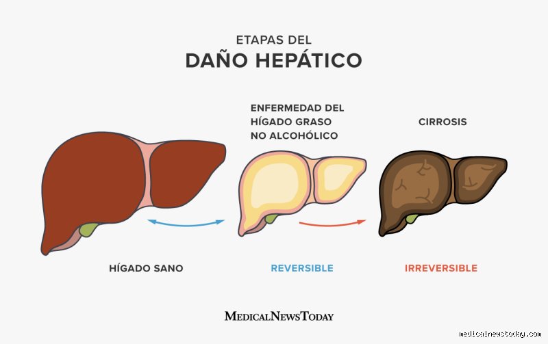 ¿Es doloroso tener hígado graso?