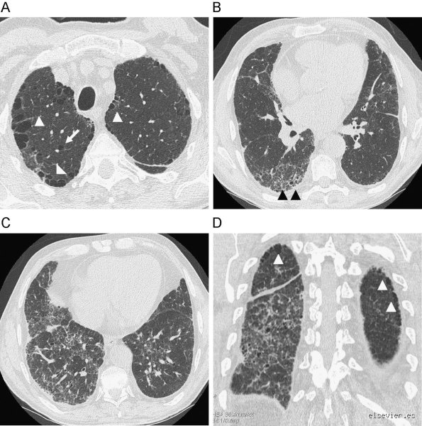 ¿Es la fibrosis pulmonar peor que la EPOC?