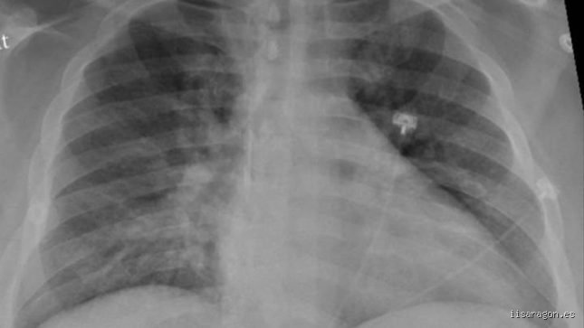 ¿Es posible recuperar unos pulmones dañados?
