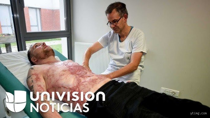 ¿Podrías sobrevivir a quemaduras del 40 por ciento?