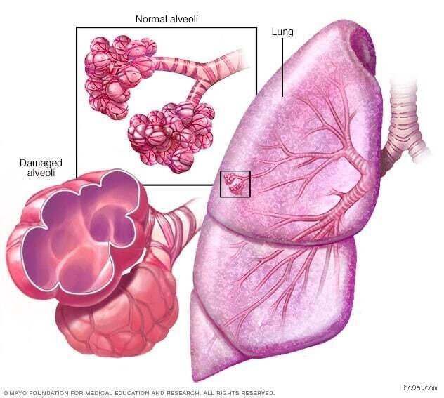 ¿Pueden los pulmones recuperarse del enfisema?